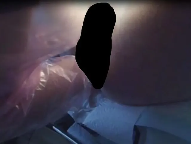 Anal Fisten