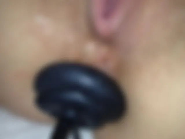Analdehnung
