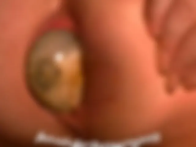 Analdehnungen